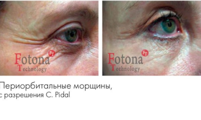 Фотона Глаза 9 Фотона Глаза 9